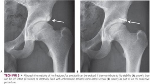 Illustration 133 for Mastering the Scope for Femoroacetabular Impingement