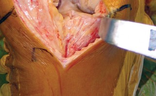 صورة طبية: استبدال مفصل الركبة بالحد الأدنى من التدخل الجراحي: ألم أقل وتعافٍ أسرع مع النهج شبه الرضفي الإنسي