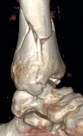 Illustration 16 for Decoding Pilon Fractures: Anterolateral and Medial Fragments Revealed