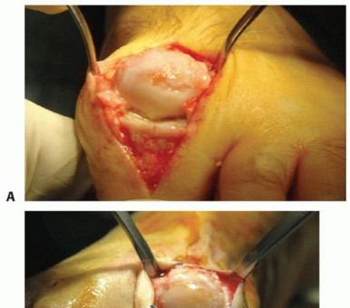 Illustration 3 for End Articular Cartilage Loss: Arthrosurface HemiCAP Resurfacing