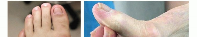 Illustration 5 for End Articular Cartilage Loss: Arthrosurface HemiCAP Resurfacing