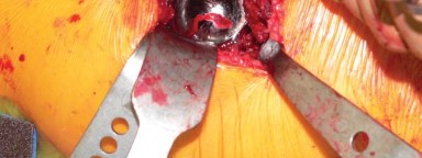 Illustration 38 for Exploring the Ambulatory Surgical Setting for Total Hip Replacement