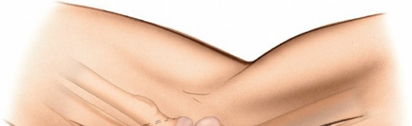 Unlocking the Coronoid: Posteromedial Approach to the Process of the Ulna