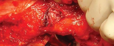 Illustration 26 for Approaches Posterolateral Surgical: A Guide to Enhanced Hip Surgery