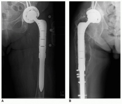 Illustration 38 for Allograft Prosthetic Composite: Mastering Proximal Femur Reconstruction