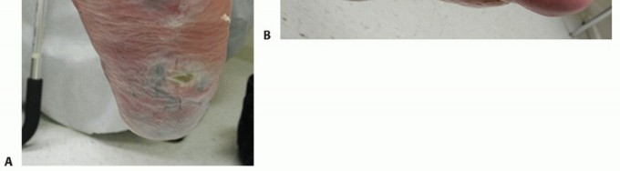 Illustration 29 for Regain Mobility: Surgical Solutions for Charcot Foot Arthropathy