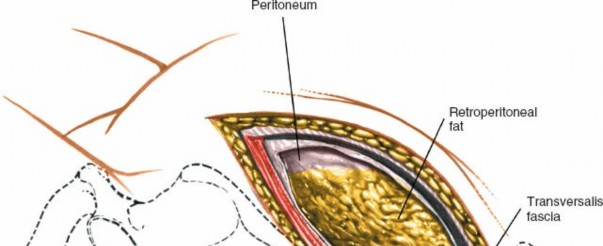 Illustration 15 for Master the Anterolateral Retroperitoneal Approach to Lumbar Spine