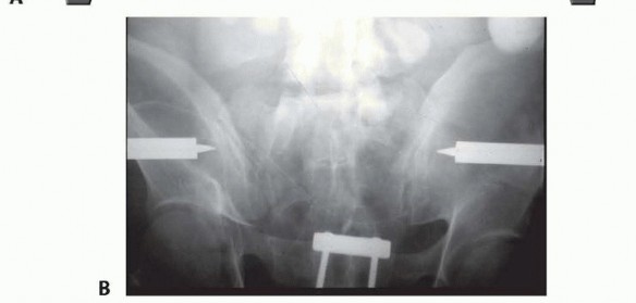 Illustration 11 for Emergency Fixation of the Pelvis: Control Bleeding & Restore Stability