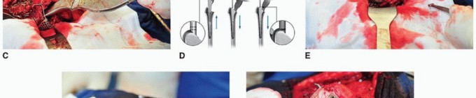 Illustration 40 for Cement in Cement Revision: Simplifying Complex Hip Revisions