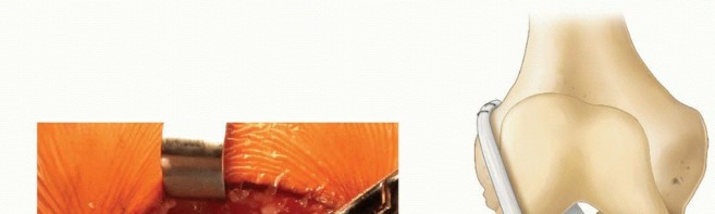 Illustration 13 for Preventing Growth Plate Risk: ACL Reconstruction Using Autogenous Grafts