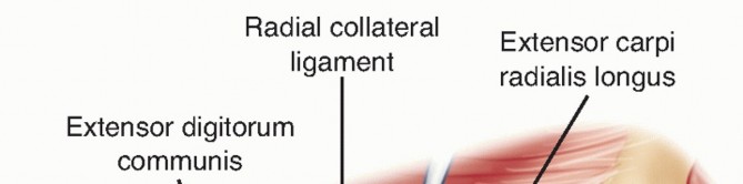 Illustration 11 for Radial Head Arthroplasty: Restoring Elbow Function & Stability
