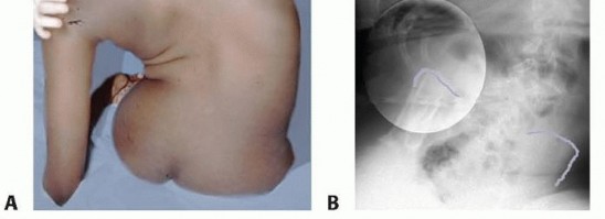 Illustration 2 for Duchenne Muscular Dystrophy: Is Spinal Fusion the Answer?