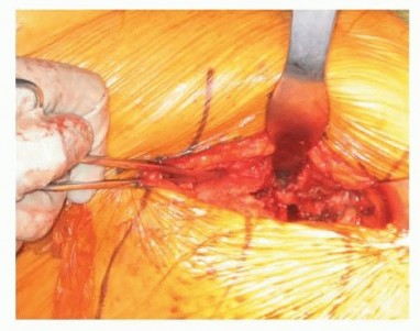 Illustration 29 for Hemiarthroplasty of the Hip: Indications & Types Explained