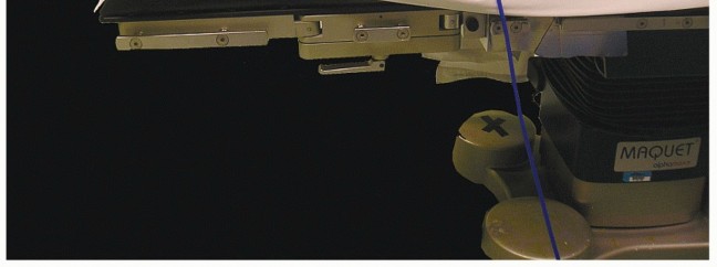 Illustration 4 for Posterior Talar Process: Endoscopic Solutions for Ankle Pain