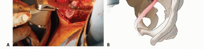 Illustration 18 for Restore Hip Health: Pelvic Osteotomy for Acetabular Dysplasia & CEA of Less