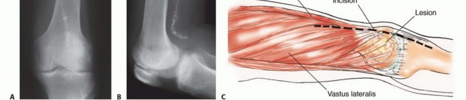 Illustration 25 for Mastering Femoral Metastases: Optimal Function for Femoris & Vastus