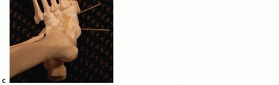 Illustration 17 for Regain Mobility: Surgical Solutions for Charcot Foot Arthropathy