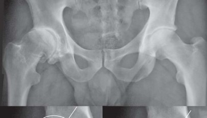 Illustration 5 for Birmingham Hip Resurfacing Designer's Technique for Active Lives