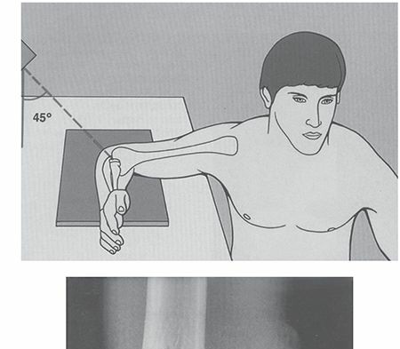 Illustration of radial head fractures - Dr. Mohammed Hutaif