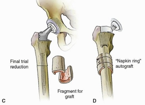 Illustration 5 for Mastering Femoral Head Autograft in DDH Hip Reconstruction