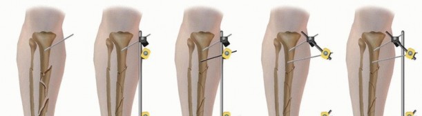 Illustration 30 for Tibia External Fixation: See How Pins Are Placed for Healing