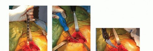 Illustration 18 for Hemiarthroplasty of the Hip: Indications & Types Explained