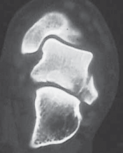 Illustration 7 for Talar Neck Fracture Treatment: Optimizing Recovery with ORIF