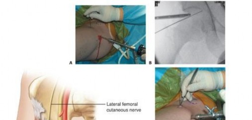 Illustration 202 for Understanding Hip Arthroscopy: The Basics Explained