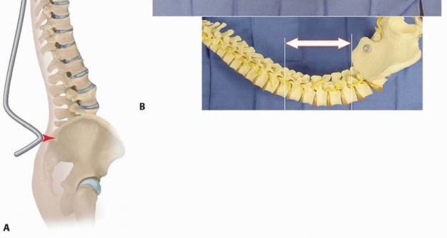 Illustration 21 for Duchenne Muscular Dystrophy: Is Spinal Fusion the Answer?