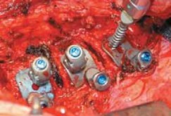 Illustration 44 for Mastering Anterior Interbody Arthrodesis with Instrumentation for Scoliosis