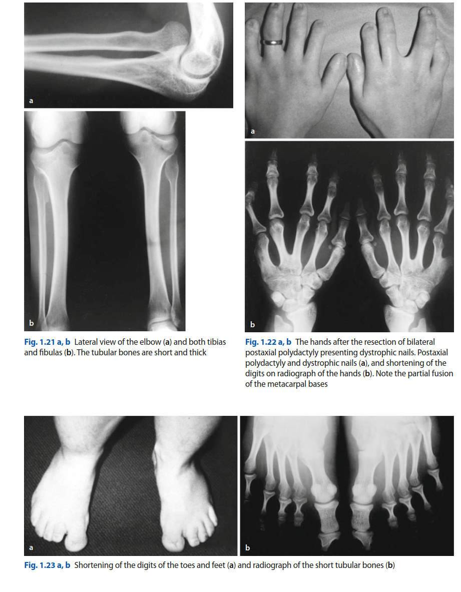 Illustration 2 for Ellis-Van Creveld's Syndrome: Uncover Key Orthopedic & Oral Signs
