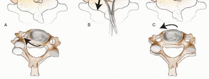 Illustration 38 for Master Techniques for Cervical Fracture Reduction: Type III & More