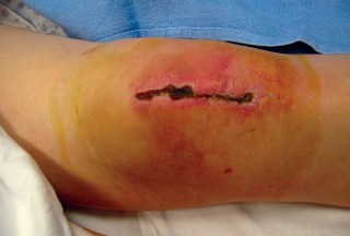 Illustration 2 for Minimally Invasive Subvastus: The Best Path to Quicker TKA Recovery