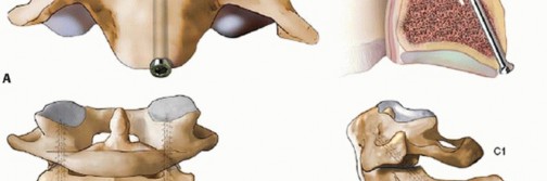 Illustration 11 for Master Techniques for Cervical Fracture Reduction: Type III & More