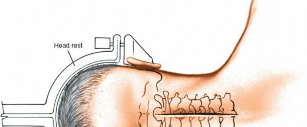 Mastering the Posterior Approach to the Subaxial Cervical Spine
