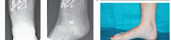 Illustration 39 for Mastering Midfoot Arthrodesis: Protect the Deep Neurovascular Bundle