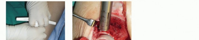 Illustration 18 for Painful Talus Lesions? The tech fig c Osteochondral Transfer Solution