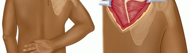 Illustration 14 for Solving Snapping Scapula: Is resection of the superomedial your option?