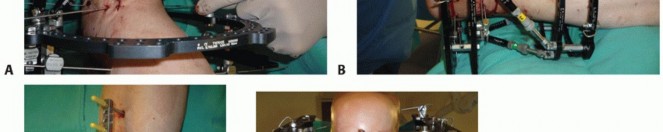 Illustration 50 for Optimize Pain Management with Proximal Ring Block for Ankle Arthrodesis