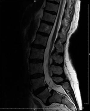 Illustration of oral questions spondylolisthesis - Dr. Mohammed Hutaif