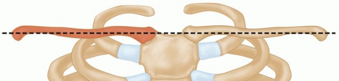 Illustration 8 for Optimizing SC Dislocation Repair After Medial Clavicle Resection