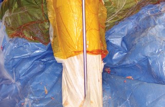 صورة طبية: استبدال مفصل الركبة بالحد الأدنى من التدخل الجراحي: ألم أقل وتعافٍ أسرع مع النهج شبه الرضفي الإنسي