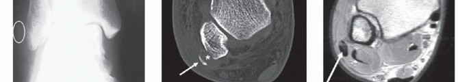 Stop Recurrent Lateral Ankle Instability: Peroneal Tendon Repair