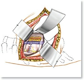 Illustration of approach to the lumbar - Dr. Mohammed Hutaif
