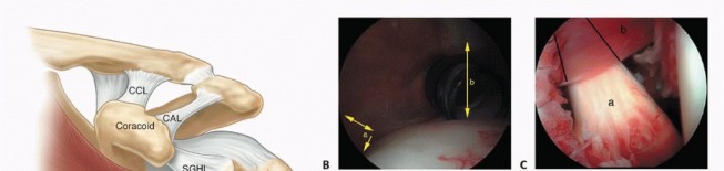 Stiff Shoulder? Discover Arthroscopic Capsular Release Solutions