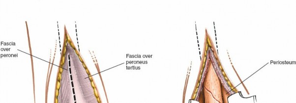 Illustration 84 for Optimized Approaches to the Dorsum of the Foot & Ankle