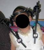 Illustration 18 for Cervical Fusion: The Line is Drawn for Lasting Stability