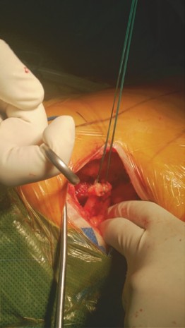 Illustration 4 for Mastering Direct Anterior Approach Hip Arthroplasty Without a Traction Table