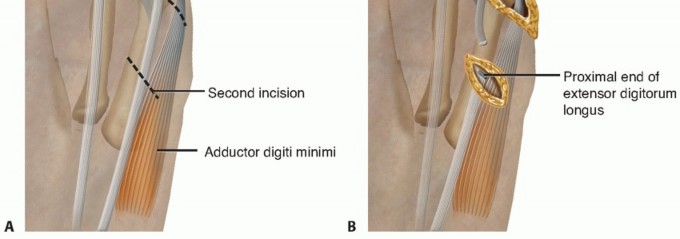 Illustration 29 for Toe Deformity Pain? Rebalance Flexor to Extensor for Relief
