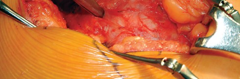 Illustration 38 for Direct Lateral Hip: Optimize Exposure with Sharp Curved Hohmann